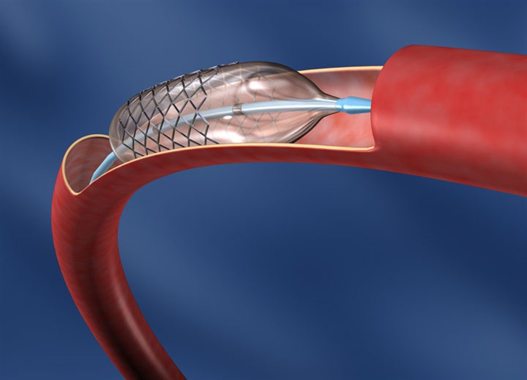 医療機器製造における加湿
